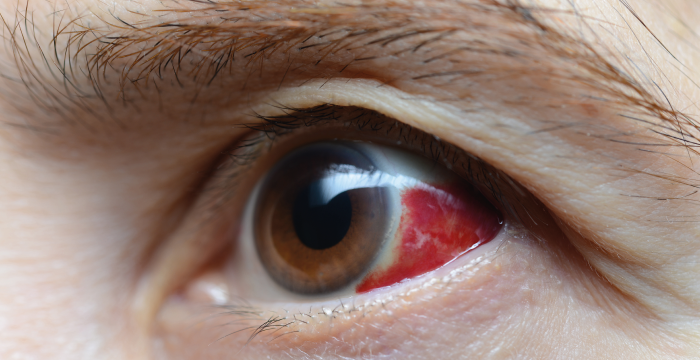 Retinopatia Diabética o que é, tipos e tratamento Hospital de Olhos