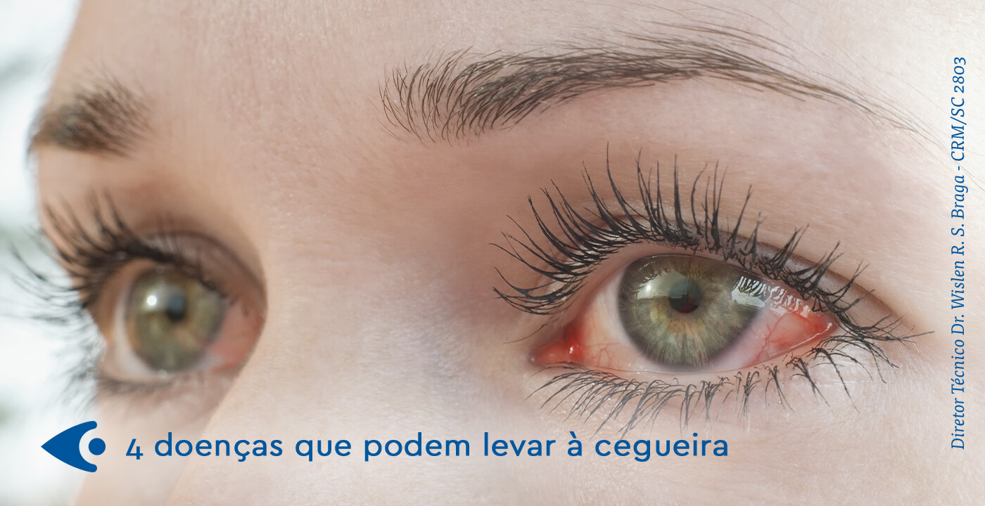 Causas da cegueira: doenças que provocam perda de visão - Clínica Tibiriça